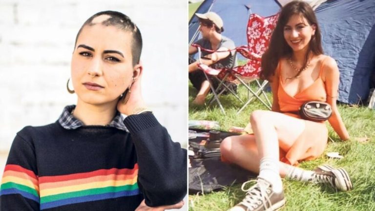 Genç kadın korona virüs nedeniyle saçlarını kaybetti