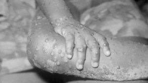 İngiltere’de iki monkeypox (maymun çiçeği) vakası daha tespit edildi