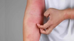 İngiltere’de maymun çiçeği (monpeypox) virüsü vaka sayısı artıyor