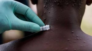 İngiltere’de maymun çiçeği vaka sayısı artmaya devam ediyor