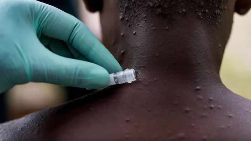 İngiltere’de maymun çiçeği vaka sayısı artmaya devam ediyor