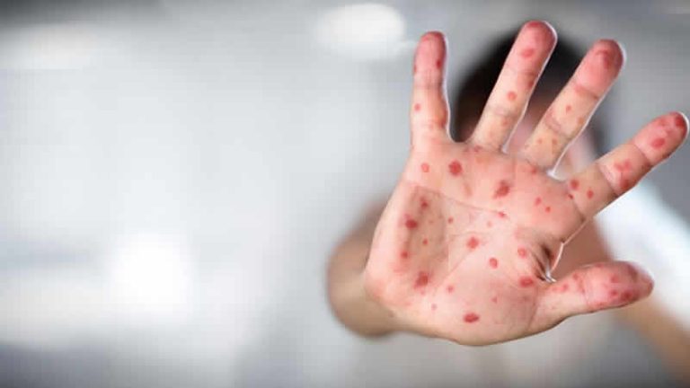 Maymun çiçeği virüsü semptomlu kişilere cinsel ilişkiden uzak durun tavsiyesi