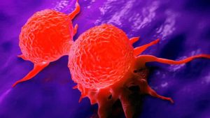 Meme kanseri tedavisi için NHS’e “metal detektörü” benzeri cihaz önerisi