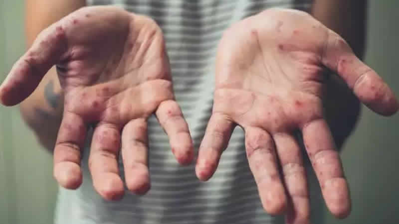 İngiltere’de maymun çiçeği vaka sayısı artıyor