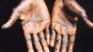 Avrupa’da maymun çiçeğinden ilk ölüm kayıtlara geçti