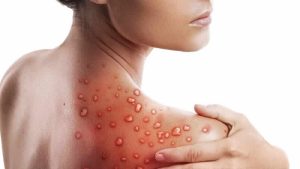 Maymun çiçeği nedeniyle ABD’nin bir eyaletinde daha OHAL ilan edildi