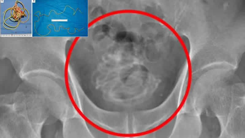 Penisinden 2 metrelik atlama ipi çıkarıldı!