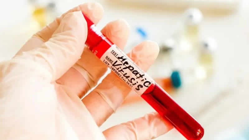 İngiltere, Hepatit-C’yi ortadan kaldıran ilk ülke olacak