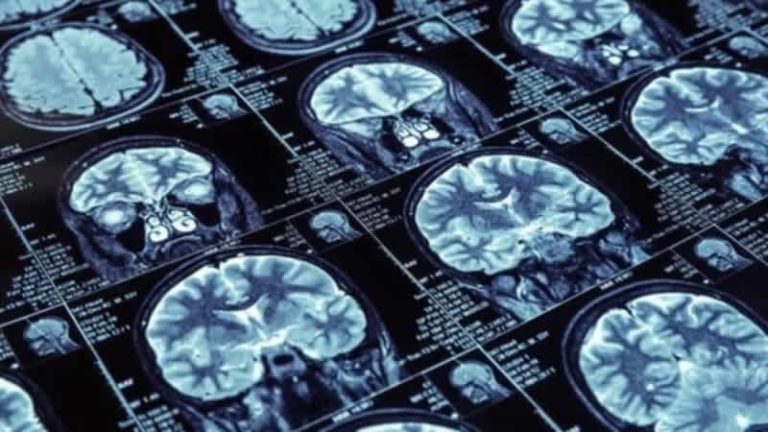 İngiltere’de Alzheimer ilaç testleri başarıyla gerçekleştirildi