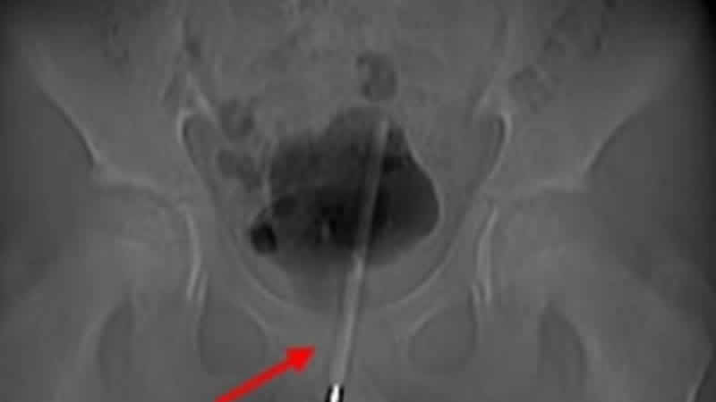 12 yaşındaki çocuğun penisinden, termometre çıkarıldı!