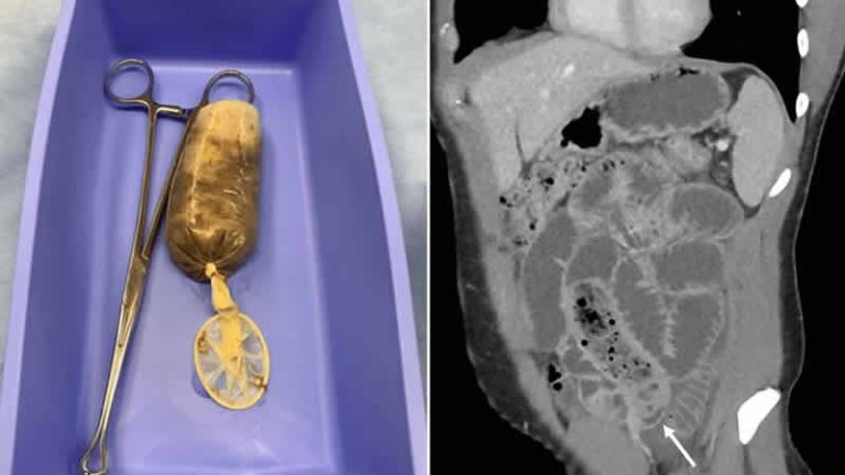 Midesinden öyle bir şey çıktı ki…!