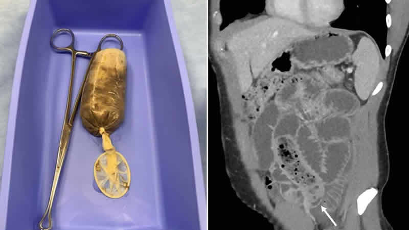 Midesinden öyle bir şey çıktı ki…!