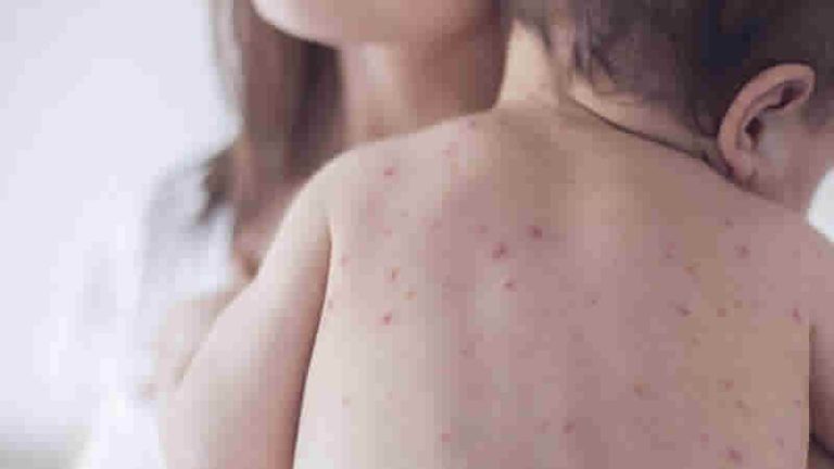 İngiltere’de genç doktorlara kızamık belirtilerin yeniden öğretiliyor!