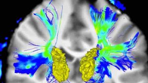 NHS yeni Parkinson ilacı Produodopa’yı satışa sunacak