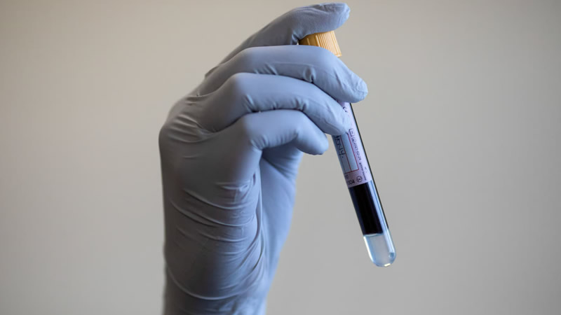 Hükümet, 12 Yaygın Kanser Türünü Tespit Eden Kan Testini Finanse Edecek