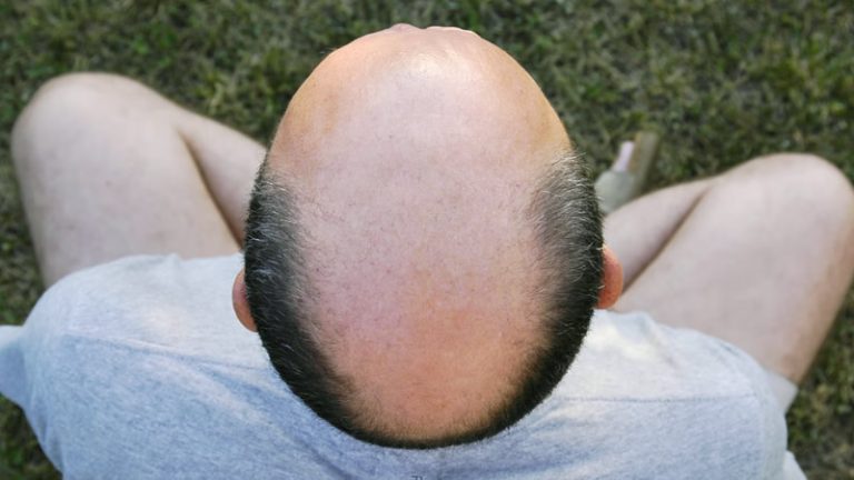 İngiltere Yüksek Mahkemesi, “Kel” Sözcüğünü Cinsel Taciz Olarak Değerlendirdi