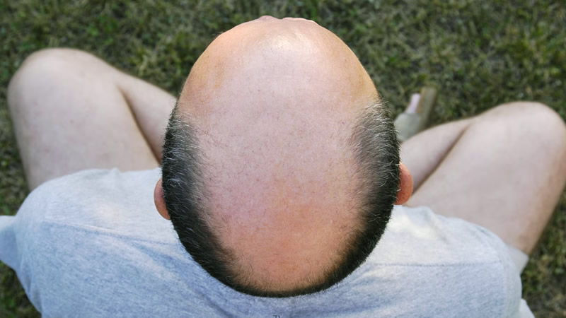 İngiltere Yüksek Mahkemesi, “Kel” Sözcüğünü Cinsel Taciz Olarak Değerlendirdi