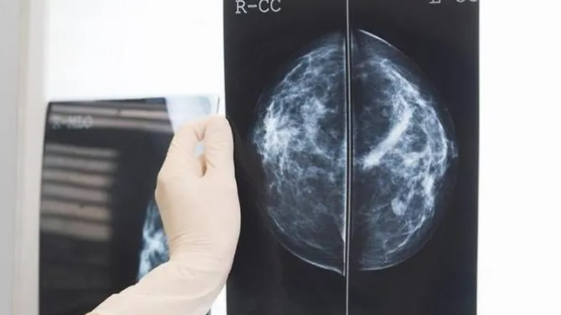 İngiltere’de Kanserde Erken Teşhis Rekor Seviyeye Ulaştı