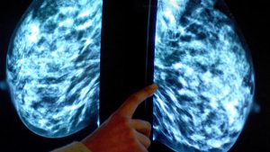 NHS, Yapay Zeka Destekli Meme Kanseri Teşhisinde Dünyanın En Büyük Denemesini Başlatıyor