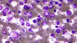 İngiltere’den Yeni Lonfoma İlacına Onay