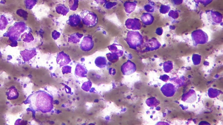 İngiltere’den Yeni Lonfoma İlacına Onay