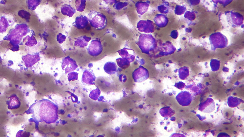 İngiltere’den Yeni Lonfoma İlacına Onay