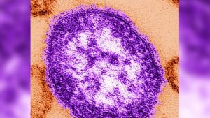 Liverpool’da Kızamık Nedeniyle Bir Çocuk Hayatını Kaybetti: Aşılama Çağrısı Yenilendi