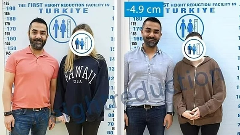 Türkiye’deki “Boy Kısaltma” Ameliyatı İngiltere Basınında