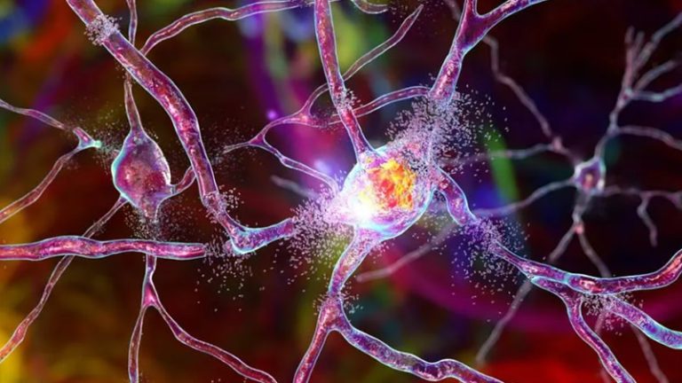 İngiltere’de Huntington Hastalığı İçin Tarihi Tedavi