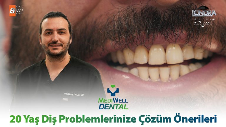 20 yaş diş problemlerinize çözüm önerileri…