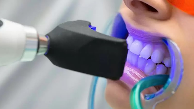 İngiltere’de Yasadışı Diş Beyazlatma Ağını Ortaya Çıkarıldı