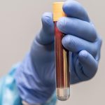 Prostat Kanseri İngiltere’de En Sık Görülen Kanser Türü Oldu